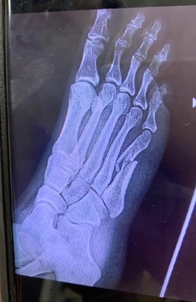 An X-Ray revealed she’d broken her foot. Picture: TikTok/nicloespinder1