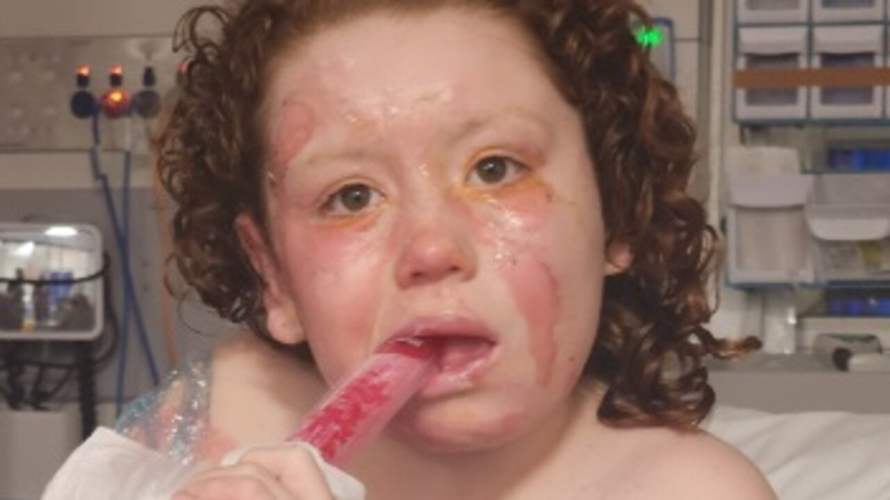 In the months since the July 2024 incident Daniella, who has autism and ADHD, underwent more than a dozen procedures and required skin grafts.