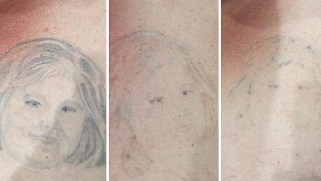 Counterpunch Tattoo Removal in Lutwyche is in the business of removing people’s regretful tattoos. Picture: Supplied