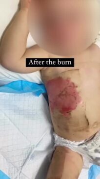 How to administer first aid for burns