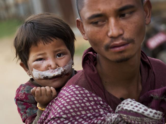 Nepalese child Subha Laxini, 3, who was injured in Tuesday’s earthquake is carried by father Lak Bahadur on their way to a camp for the displaced in Chautara, Nepal, Wednesday, May 13, 2015. Nepal, just beginning to rebuild after a devastating April 25 earthquake, was hit by a magnitude-7.3 quake Tuesday. (AP Photo/Bernat Amangue)