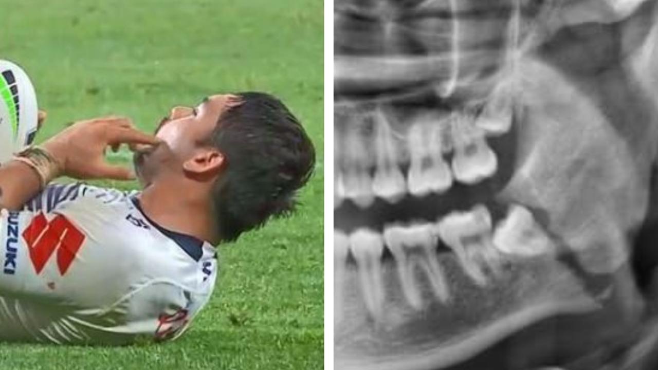 Brandon Smith suffered a broken jaw against the Eels.