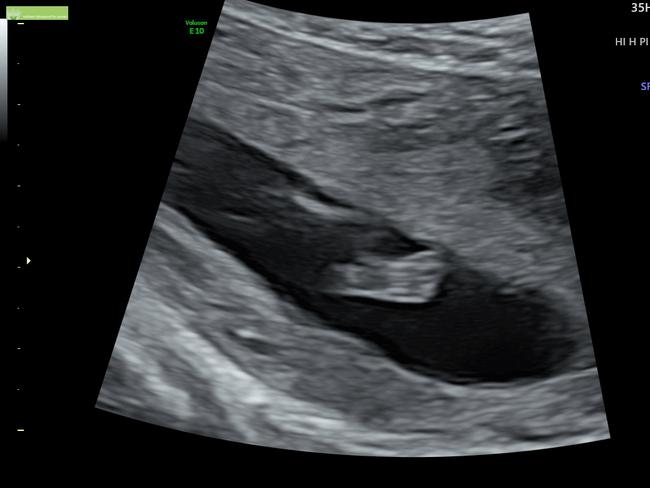 The baby’s left foot, viewed from underneath.