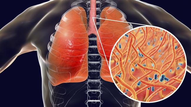 Whooping cough is a highly contagious infectious disease caused by Bordetella pertussis bacteria. The main symptoms are paroxysms of cough and inspiratory whoop.