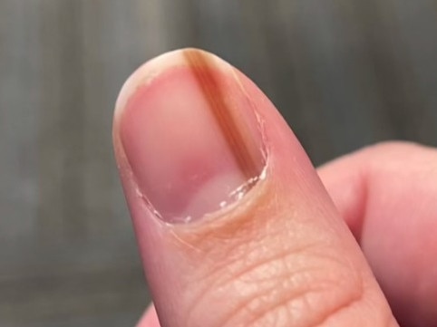 The dark streak on Maria’s thumb that she thought was ‘cool’. Picture: TikTok/invrfoundwaldo