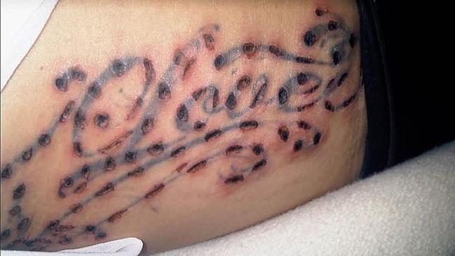 When tattoo removals go horribly wrong 