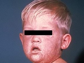 Health authorities have issued a warning to residents after a traveller with a highly infectious disease was detected in a major city. NSW Health was notified of a traveller with a confirmed case of measles who took an international flight to Sydney and visited several locations in the city. The person returned from South-East Asia, which are currently reporting measles outbreaks, incuding Thailand, Vietnam, and Indonesia.