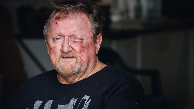 Jimmy Marshall, who was robbed in his Malak home by a group of young people overnight. They smashed through a glass door, knocked him from his wheelchair and bashed him before driving off in his car. Picture: Glenn Campbell