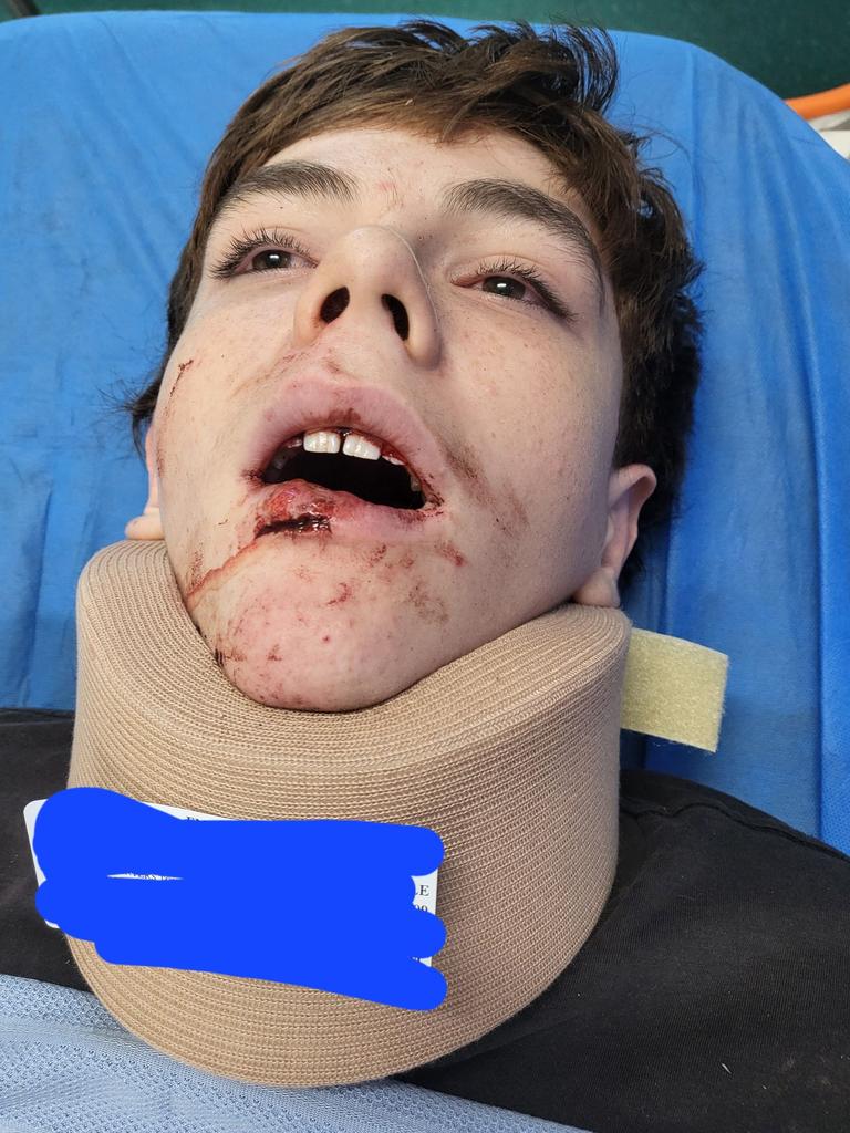 Zavier Harper, a 15-year-old leukaemia survivor sustained facial injuries after crashing his scooter on Thursday. He was flown to Townsville University hospital due to the lack of CT scanner at Charters Towers hospital.