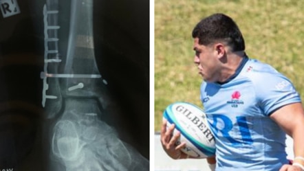 The damage to Onito Finau in a rugby game.