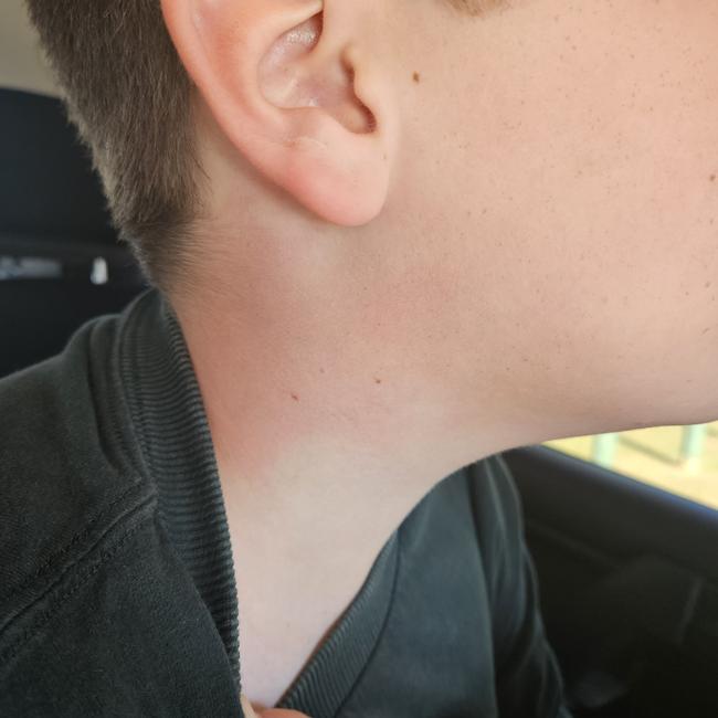 A red mark on the boy’s neck after he was allegedly king hit. Picture: Supplied