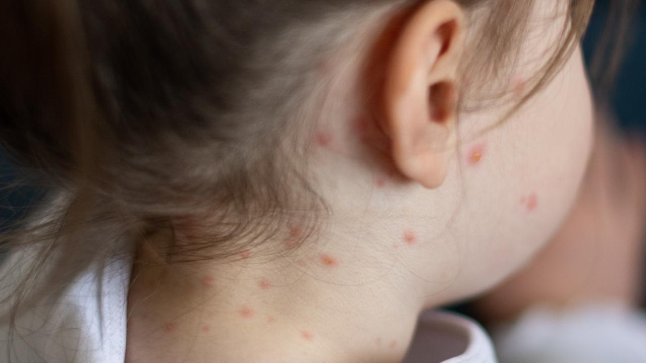 Upper back of young woman contracted chickenpox and red rash