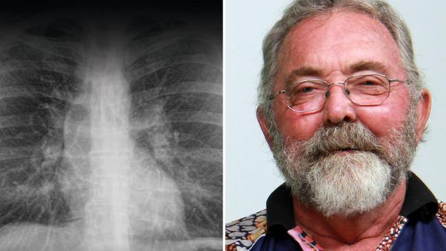 ‘Cough in the morning’: Lung disease cases skyrocket as 150,000 workers tested