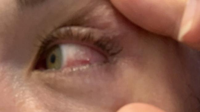 My eye just before I saw the doctor.