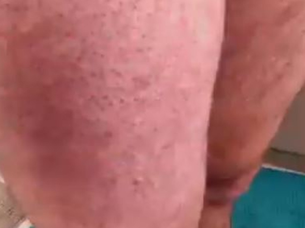 Mr Billing shared a video of his leg after the coffee spill. Supplied