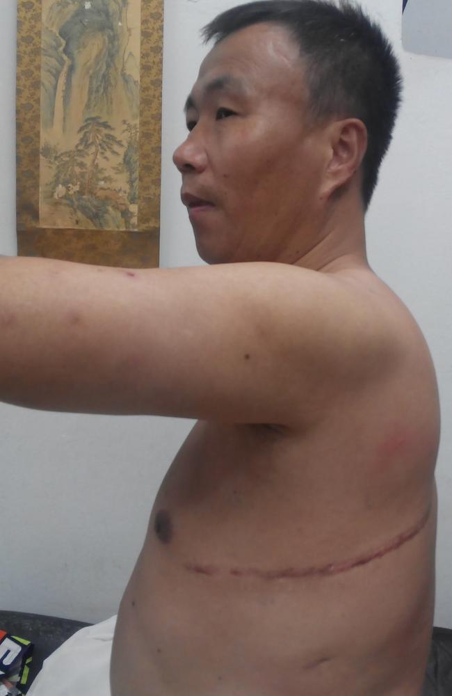 Mr Cheng's massive visible scar from the barbaric surgery he was forced to undergo.