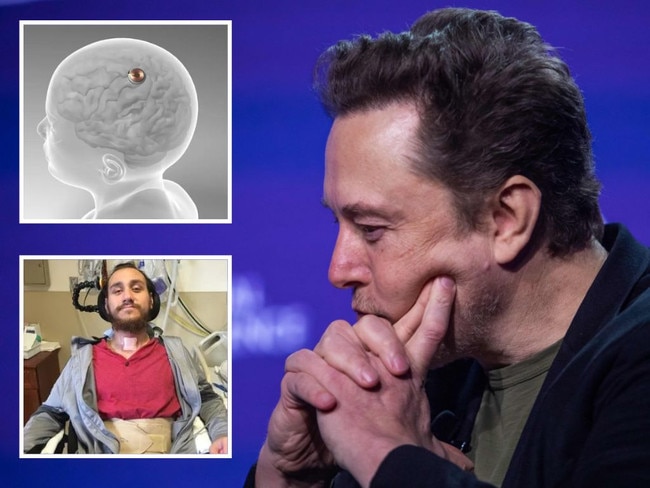 Elon Musk’s brain-chip startup Neuralink suffered an unexpected problem in its first-ever human implant.