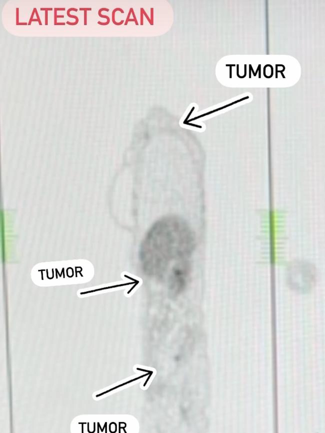 Emma Gorrick, 35, of Cromer, was diagnosed with re-occurring breast cancer in January 2020 which had spread to her bones and liver. This scan was taken in March 2021 after she pursued natural therapies. Picture: Supplied.