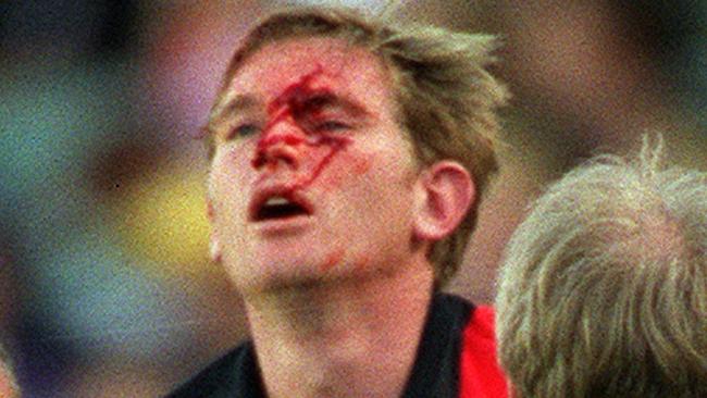 James Hird after colliding with another player and injuring his face during his playing days.