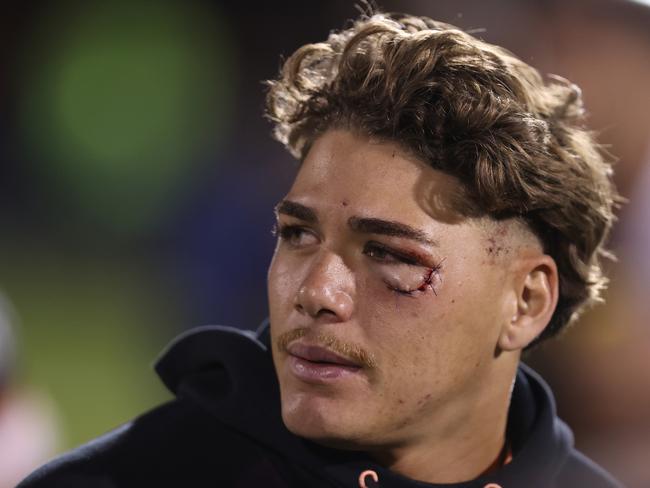 Reece Walsh shows the after-effects of a collision with Penrith’s Taylan May earlier this season. Picture: Jason McCawley/Getty Images