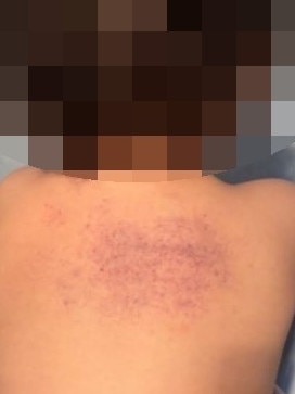 Photos of the bruises allegedly left by childcare worker Angela Evans.