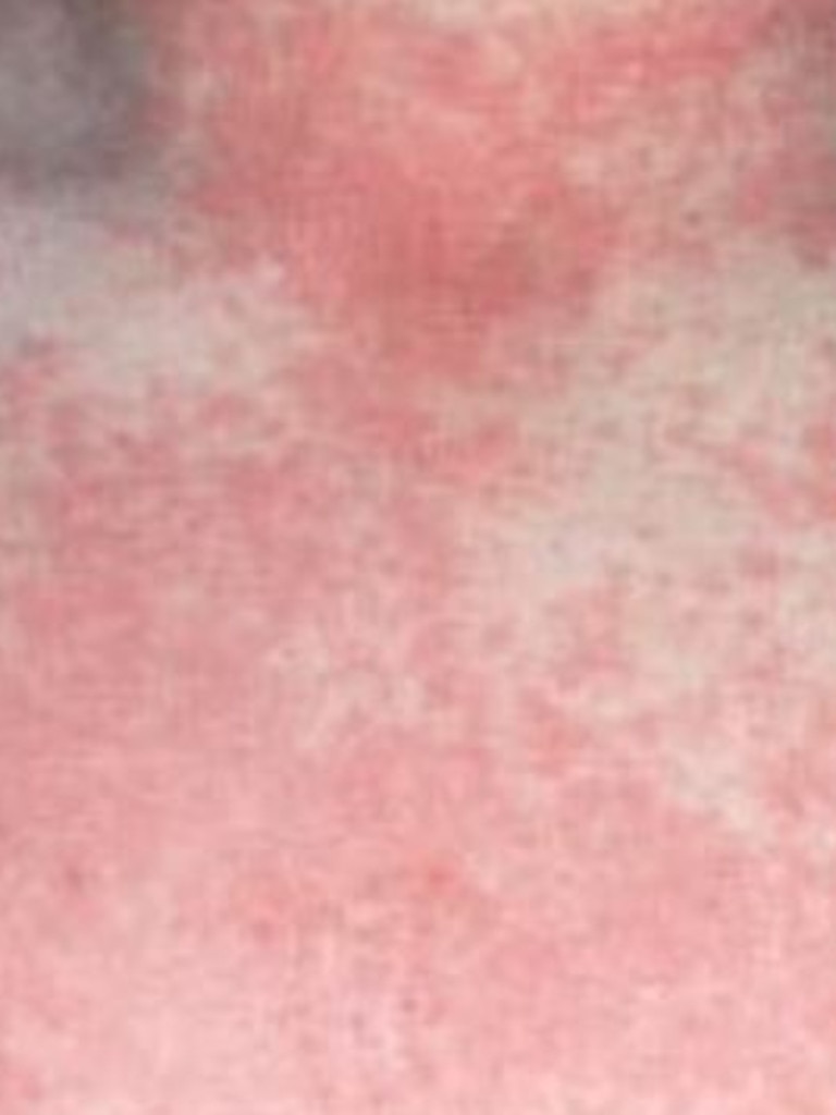 The virus causes a rash like this one. (picture: Facebook)