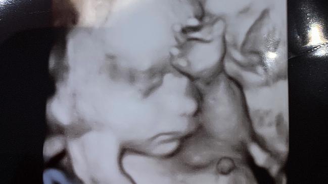 Courtney Thorpe’s unborn daughter pictured in her 25-week ultrasound image.