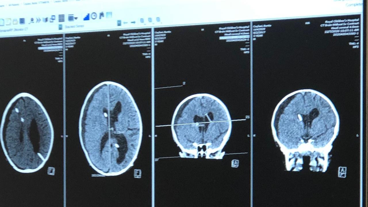 Bertie Ceylani has a MRI every three months to see if his cysts have returned or grown.