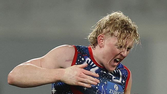 Clayton Oliver fractured his right thumb last week and required surgery. Picture: Getty Images