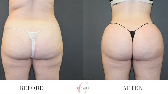 Before and after Brazilian butt lift photos on the Cosmos Clinic website. Picture: Supplied