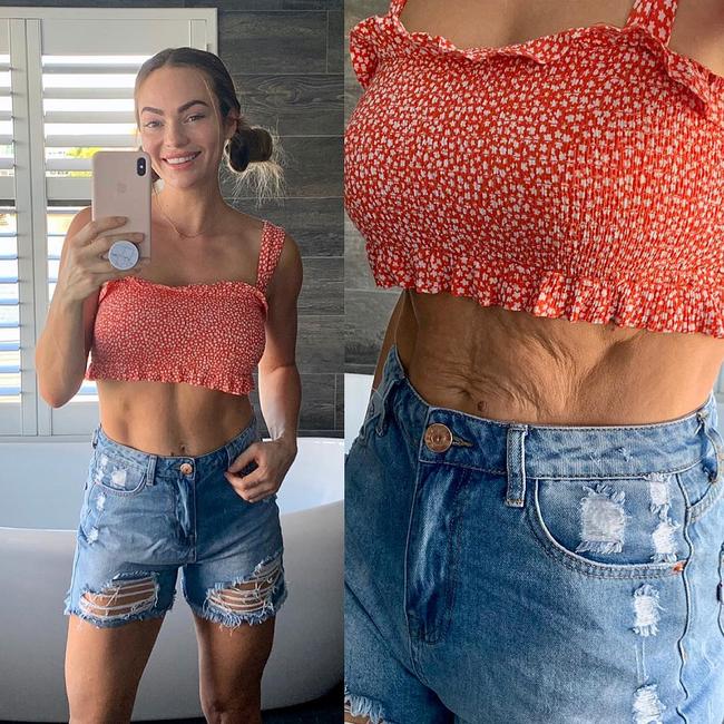 Emily Skye shared a brutally honest image showing her lose skin more than a year after giving birth.