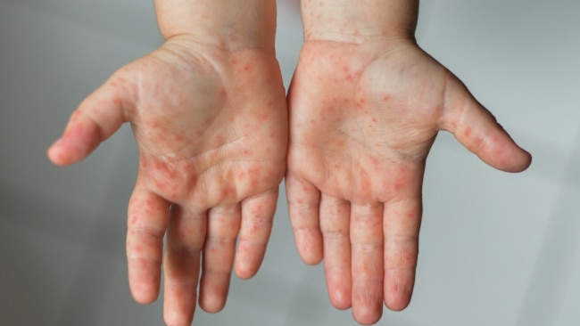 Symptoms include fever, cough, runny nose and sore red eyes, followed by a red spotty rash which starts on the head and spreads to the rest of the body. Picture: Getty Images