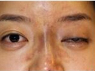 A South Korean woman who went blind in one eye after getting dermal filler injected.