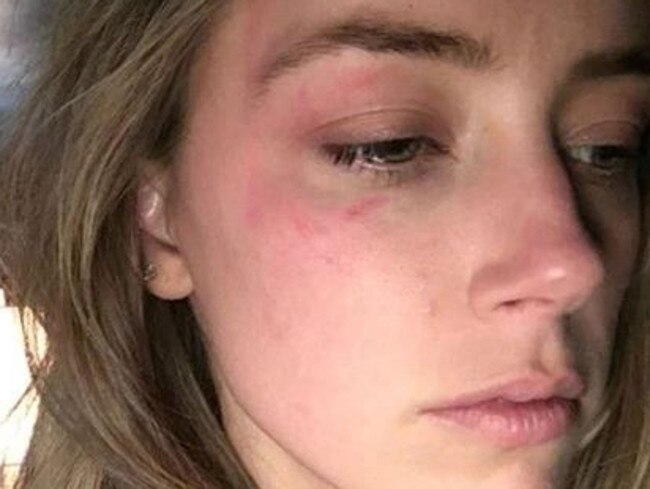 Amber Heard claims Johnny Depp hit her with a cell phone.