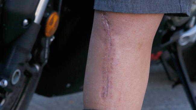 The scar on Jack Miller’s leg. Picture: Getty Images