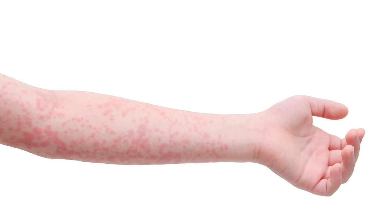 Raised red bumps on the skin could be a sign of a food allergy. Picture: supplied