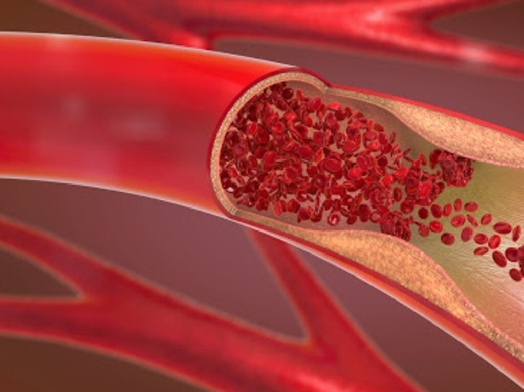 Thrombosis with thrombocytopenia is a rare blood clotting syndrome that has Australia’s attention.