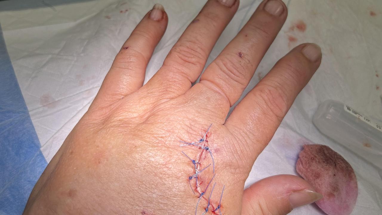 Mrs Mills said her wound required seven stitches to close, and she was given a tetanus shot.