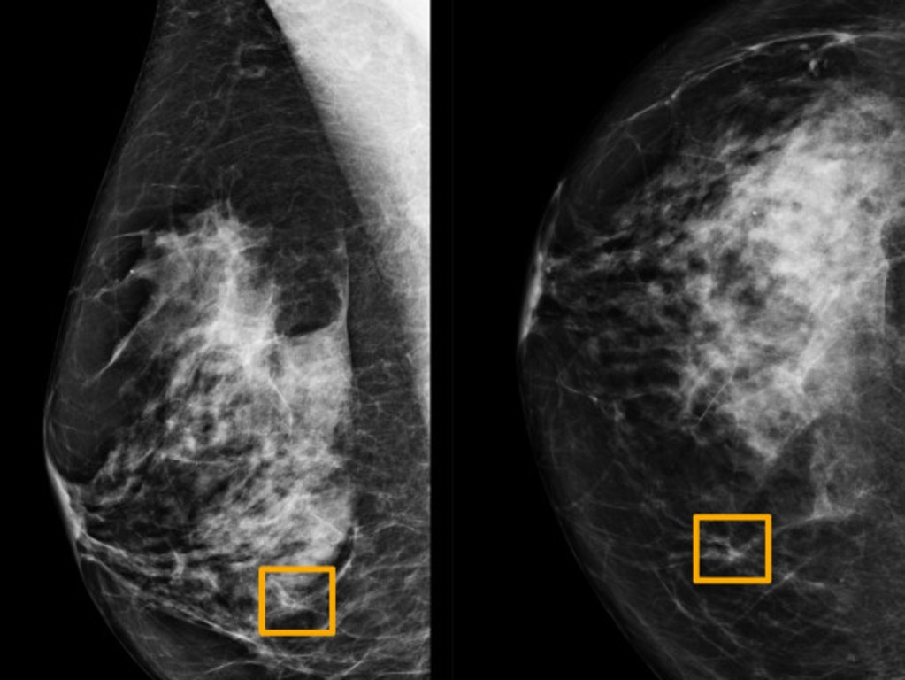 A yellow box indicates where an artificial intelligence (AI) system found cancer hiding inside breast tissue. Picture: Reuters