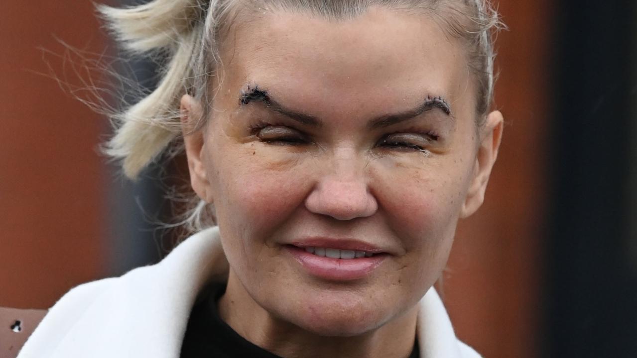 Jaw-dropping photos of Atomic Kitten star Kerry Katona post-eyelift |  Herald Sun