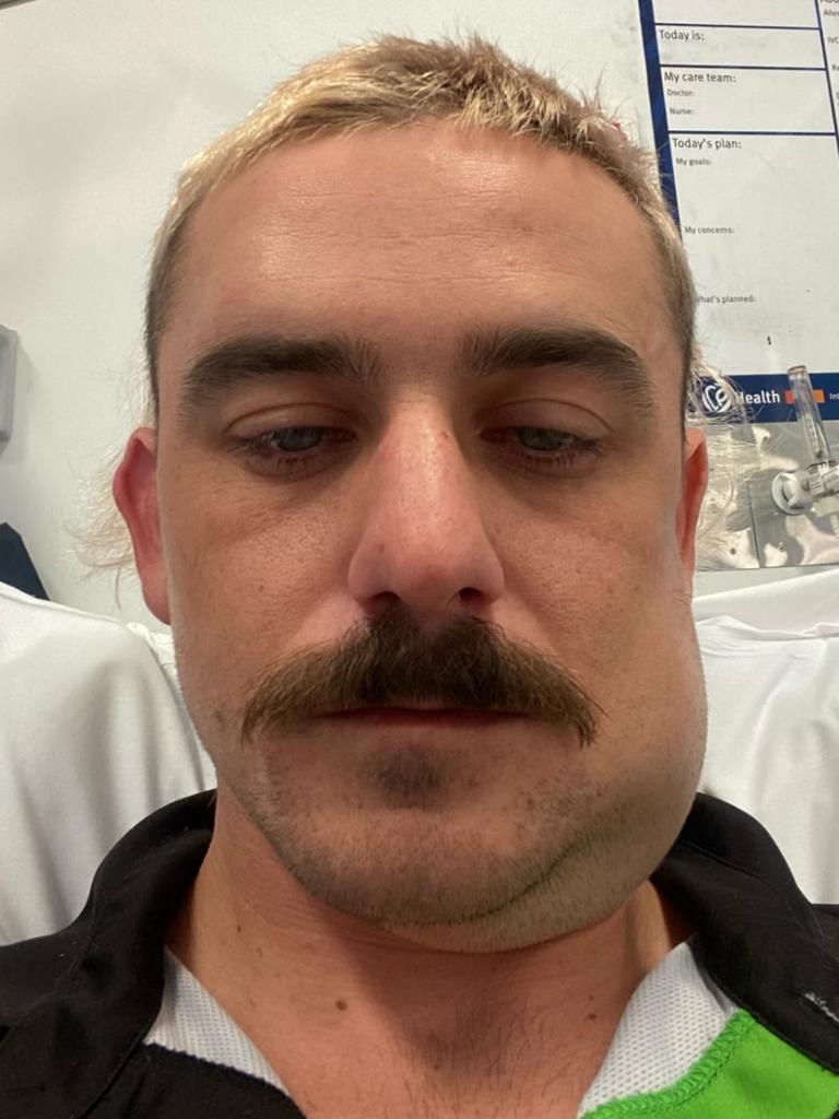 Jockey Ashley Butler in Rockhampton Hospital after being king hit at a licensed premises in the city’s CBD after his win in The Archer. Picture: Supplied.