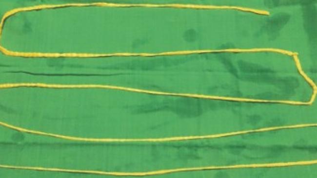 Yep. That’s a two-metre tapeworm. Source: New England Journal of Medicine