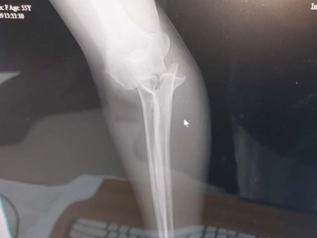 An X-ray shows where she had plates and screws inserted to help piece her broken bones back together. Picture: WMUR