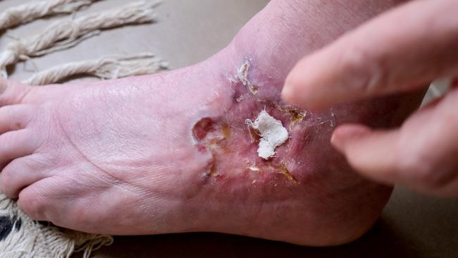 Leopold resident Bev O’Meara caught the Buruli ulcer after a bite on her ankle. Picture: Mark Wilson