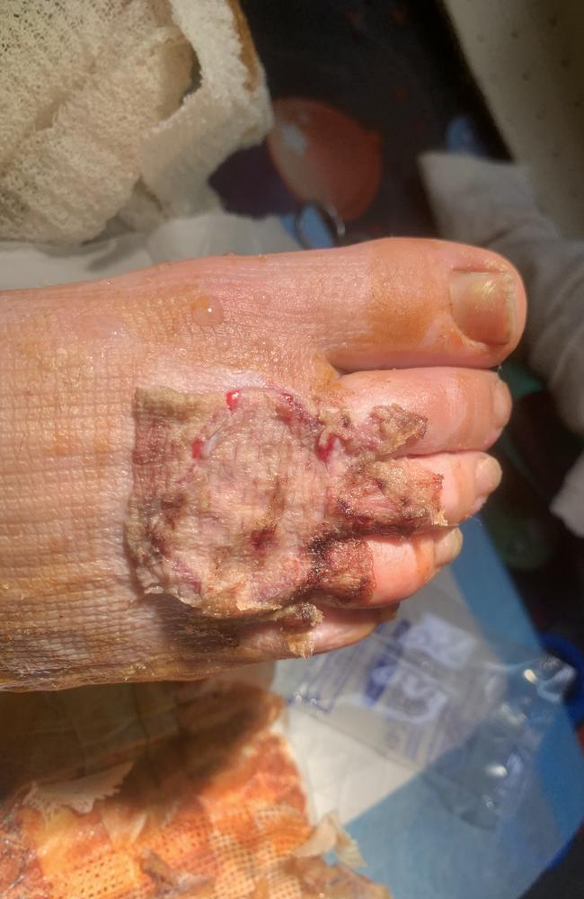 Caitlin needed a skin graft and says she’s still not completely healed almost four years on. Picture: Supplied