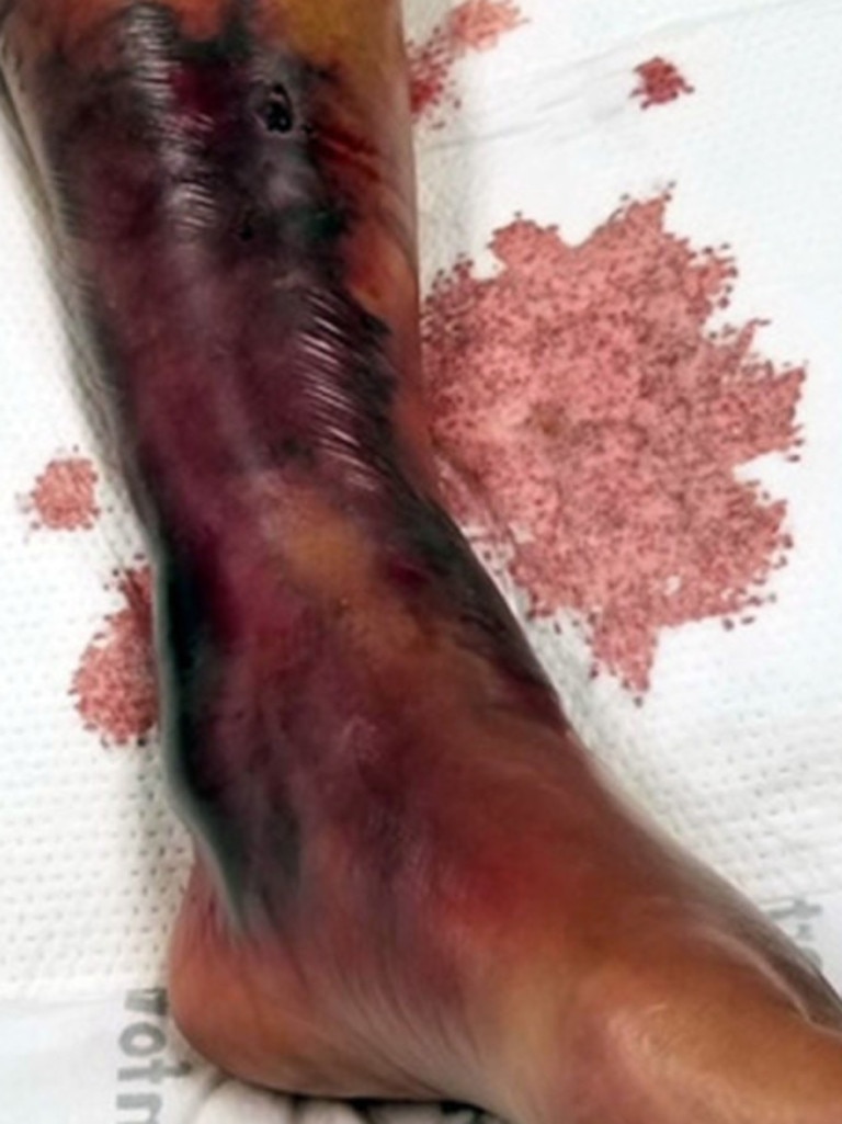 Horrifying photos show how the bottom half of Lynn's leg became ravaged just days after getting a small cut.