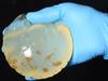 Melbourne cosmetic surgeon Dr Simon Rosenbaum says there is an alarming increase in patients coming to him with botched breast implants after travelling to Thailand for cheap rate procedures. Dr Rosenbaum with a defective implant he removed from a patient. The inclusions that are visible are not normal. Picture: Lawrence Pinder