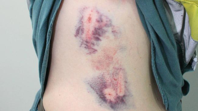 Ergon Energy file photos of previous injuries on meter readers.