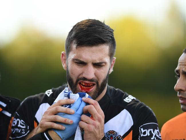 James Tedesco is out for the season with a broken jaw.