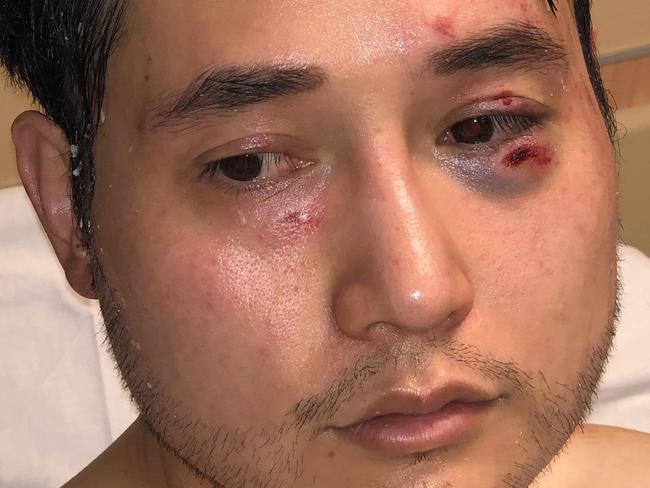 Journalist Andy Ngo was attacked at an Antifa protest in Portland, Oregon.  Supplied